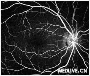 Stargardt病 荧光素造影